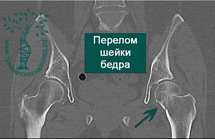 Реферат: Перелом шейки бедра